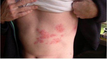 الهربس النطاقي